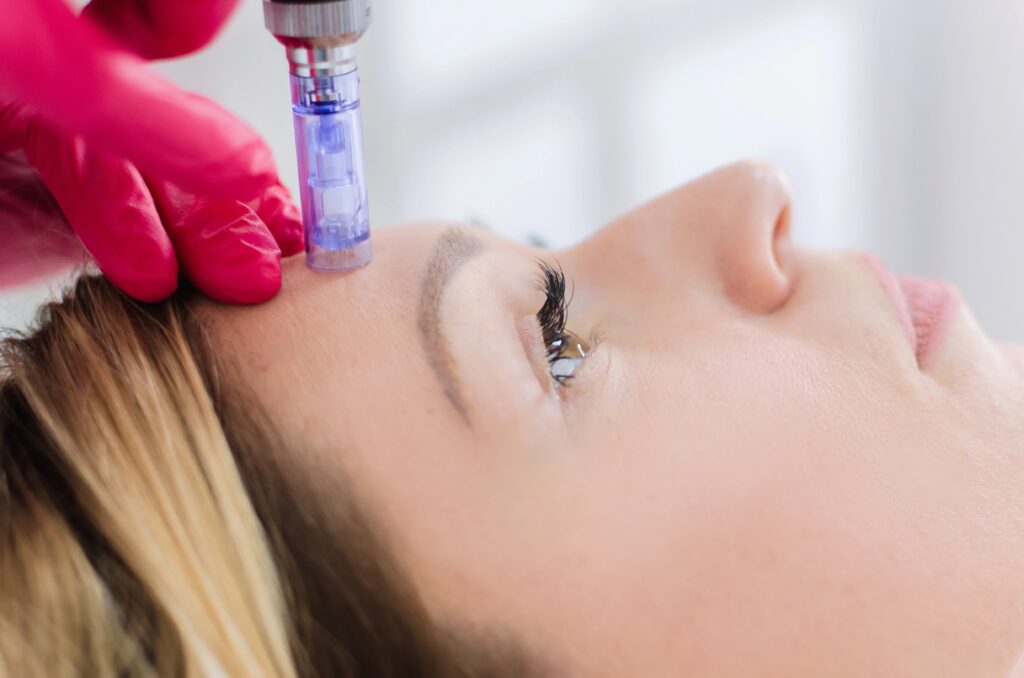 Close-up of young woman receiving microneedling treatment